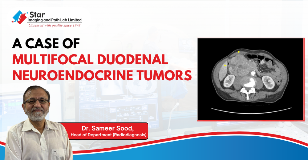 Rare Intestinal Tumors: What You Need to Know