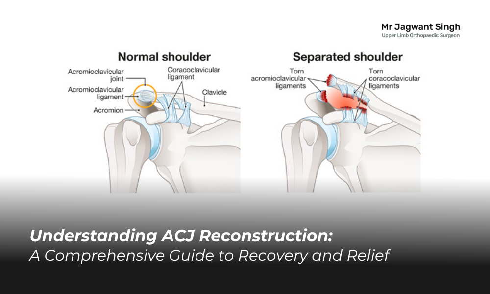 Understanding ACJ Reconstruction: A Comprehensive Guide to Recovery and Relief