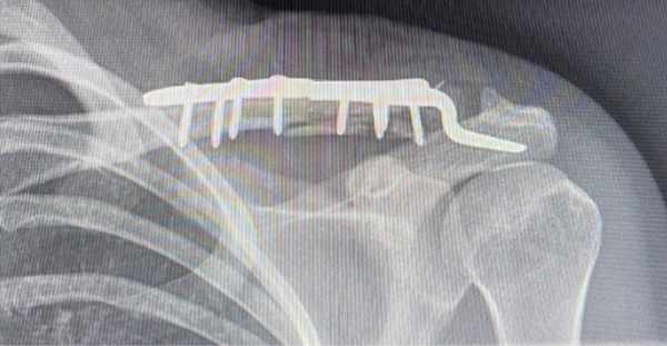 ACJ Reconstruction: A Complete Guide from an Orthopedic Surgeon in London