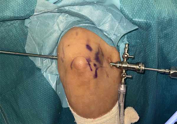 Relieve Pain, Restore Motion: Arthroscopy of the Elbow