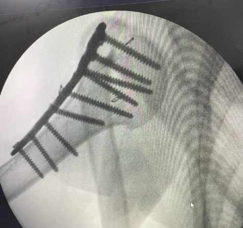 Open Reduction Internal Fixation Surgery: A Complete Guide to Internal Fixation Surgery