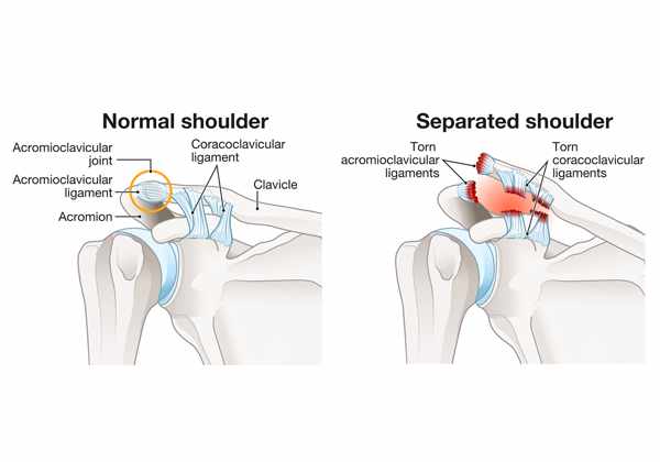 What Does ACJ Reconstruction Surgery Involve?
