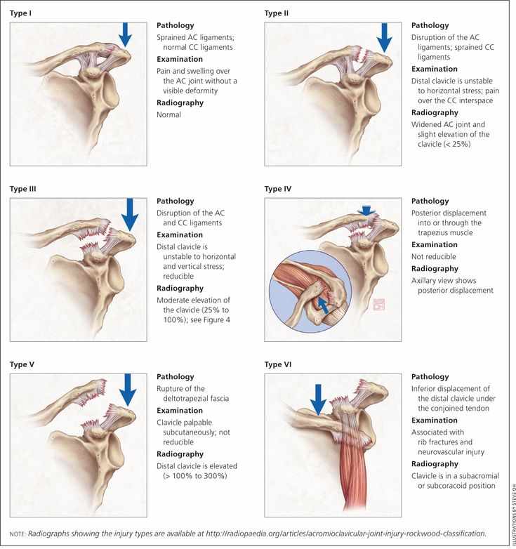 Why ACJ Joint Injuries and Dislocations Are Common in London Athletes