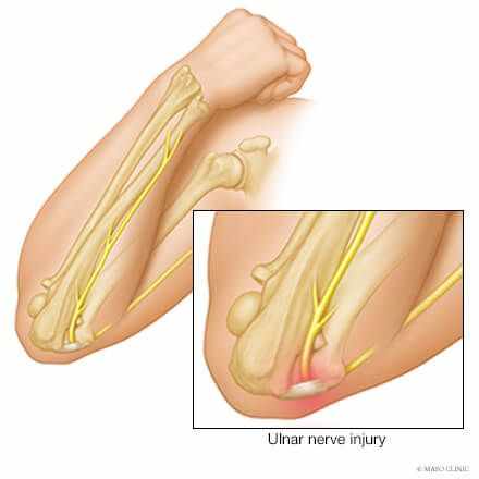 Why London Patients Are Choosing Ulnar Nerve Decompression Surgery for Cubital Tunnel Syndrome