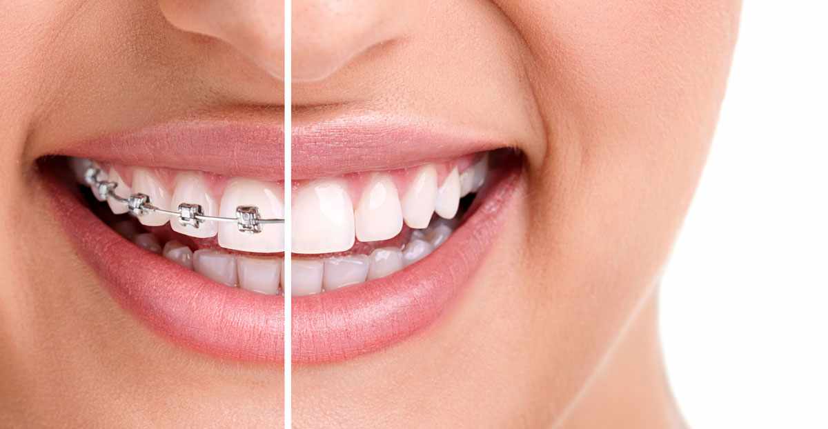 Eastvale Braces Specialist in Corona, CA