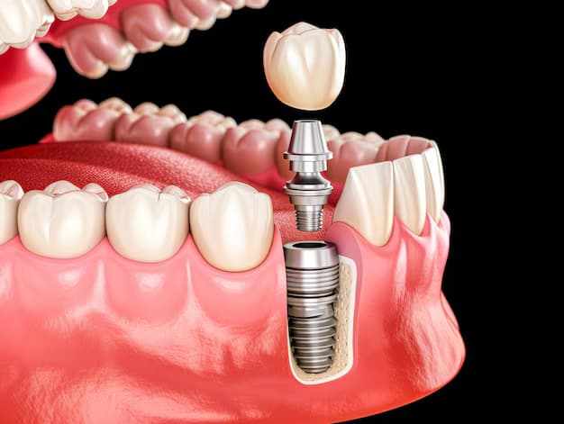 Dental Implants in Essex: A Long-Lasting Tooth Replacement