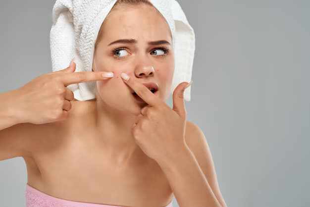 Acne Removal Cream: How It Works on Active Acne