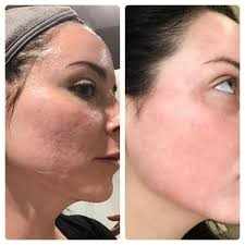 HOW DO CO2 LASER RESURFACING TREATMENTS ENSURE THE BEST RESULTS?