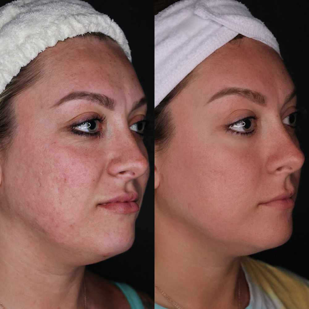 Morpheus8 Before and After at RejuvaMed Skin Clinic