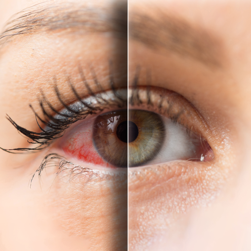 Best Oculoplastic Surgeon in Delhi NCR: Why Expertise Matters in Eye Surgery