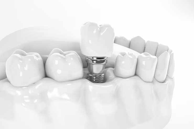 Dental Implants in Thousand Oaks: Procedure, Costs, and Benefits