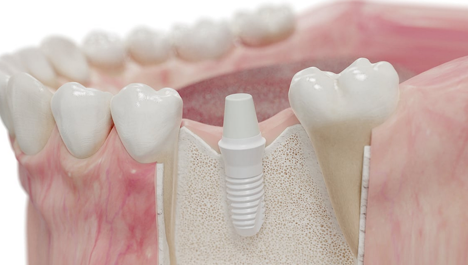 What to Expect When Getting Dental Implants in Wilmslow