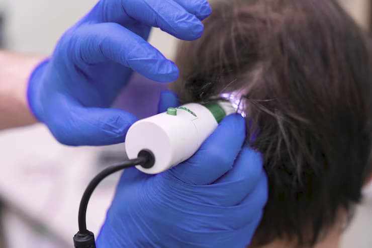 Safe and Effective Laser Hair Growth Now Available in Birmingham