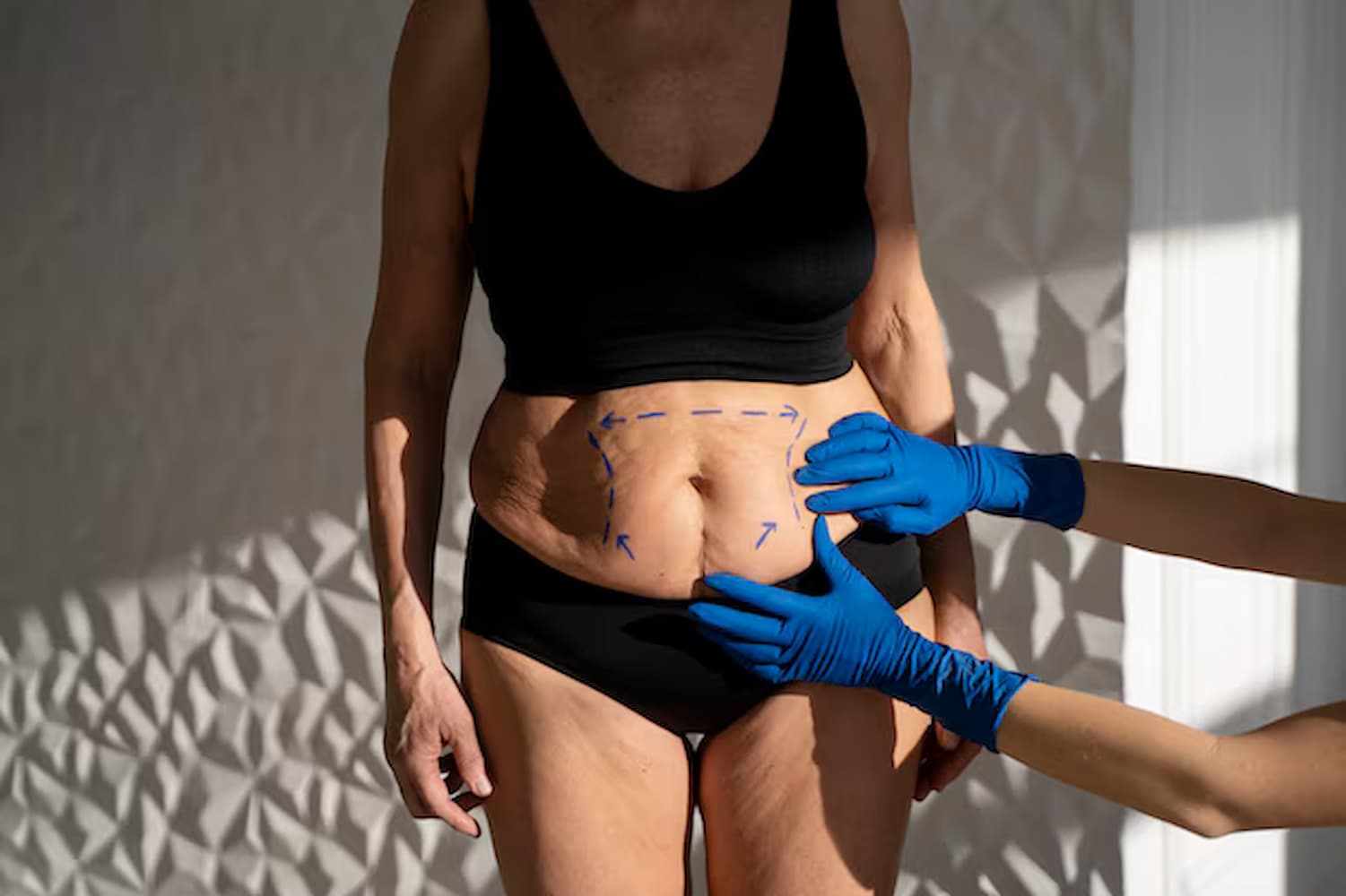 Cost of Emsculpt Treatment in Birmingham