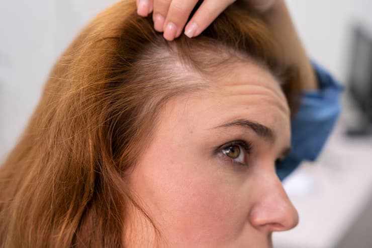 Hair Loss Solutions That Work: Edinburgh’s Alopecia Experts