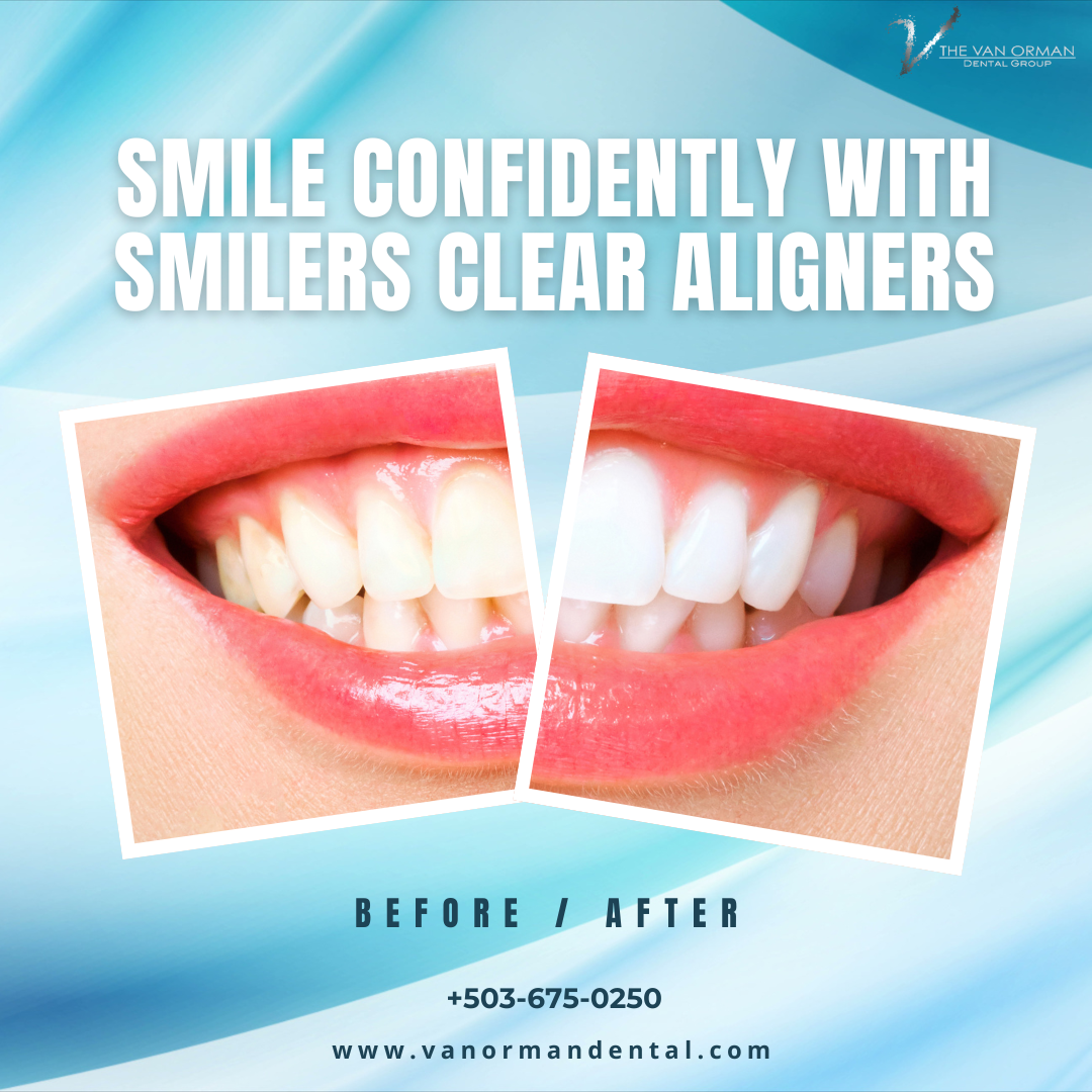 Are Smilers Clear Aligners Right for You ?