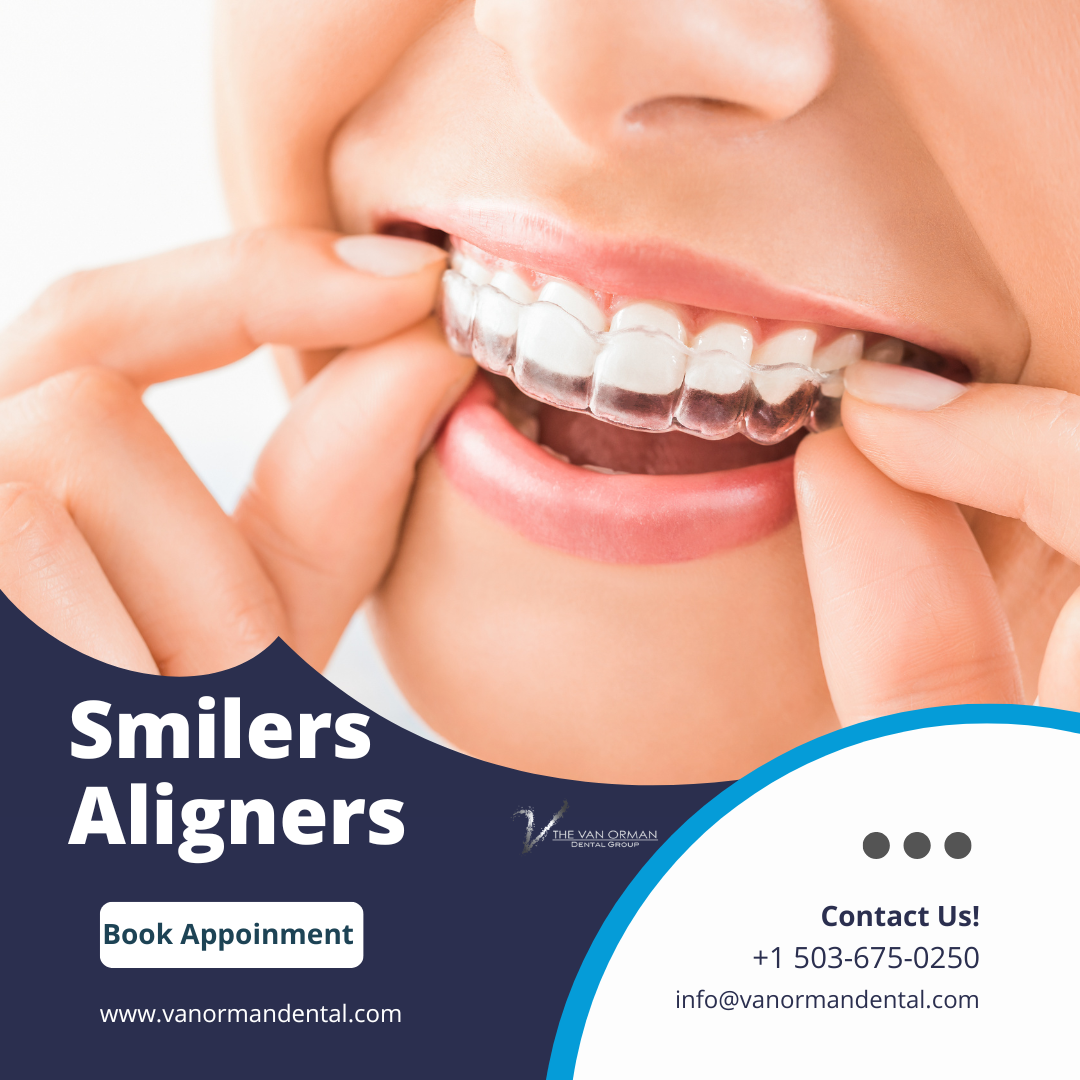 How Do Smilers Aligners Work?