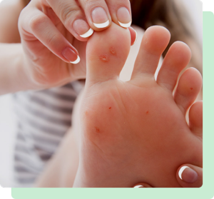 Cure For Warts On Feet South Amboy