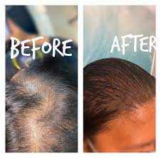 Hair Thinning Services in Winnipeg