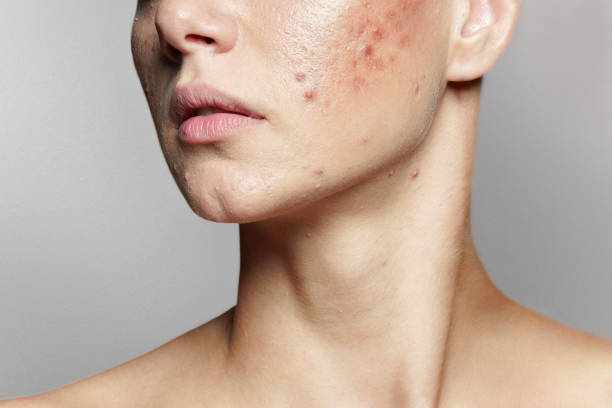 Pioneering Clearer Futures: Galderma S.A.’s Role in Shaping Taiwan Professional Acne Medication Market