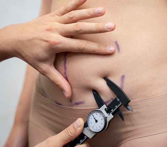 Tummy Tuck Surgery in Delhi by Dr. Lokesh Handa