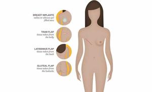 What Kind of Breast Surgery Should You Get - Dr. Lokesh Handa