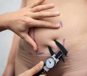 Discover Excellence in Tummy Tuck Surgery with Dr. Lokesh Handa