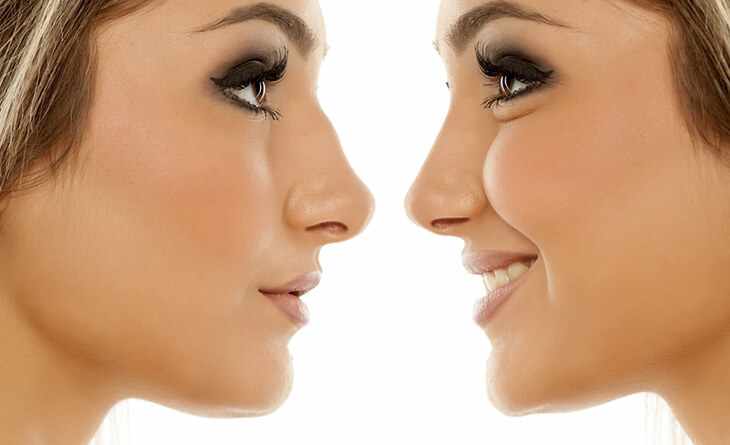 "Result-Specific Rhinoplasty Surgery by Dr. Lokesh Handa at Med Esthetiks "