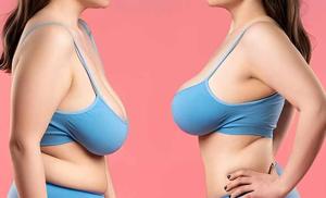 Elevate Your Beauty: Breast Lift Surgery by Dr. Lokesh Handa