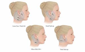 Find Your Youthful Face with Facelift Surgery by Dr. Lokesh Handa, Med Esthetik