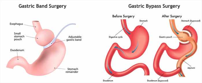 Gastric Banding Surgery Cost, Recovery, and Results