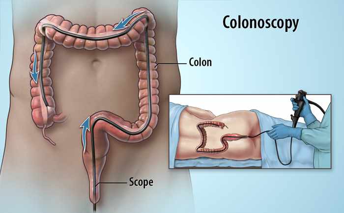 Colonoscopy Screening Singapore: Protecting Your Health Through Early Checks
