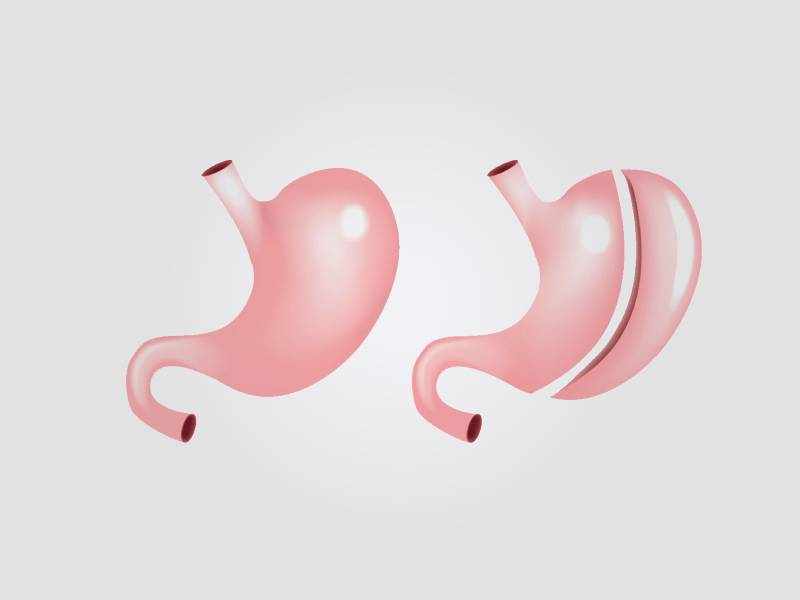 Life After Laparoscopic Sleeve Gastrectomy: Diet, Lifestyle & Success Stories