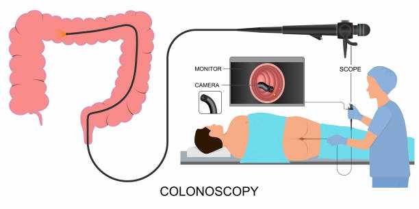 Colonoscopy Screening Singapore: When Should You Get Checked?