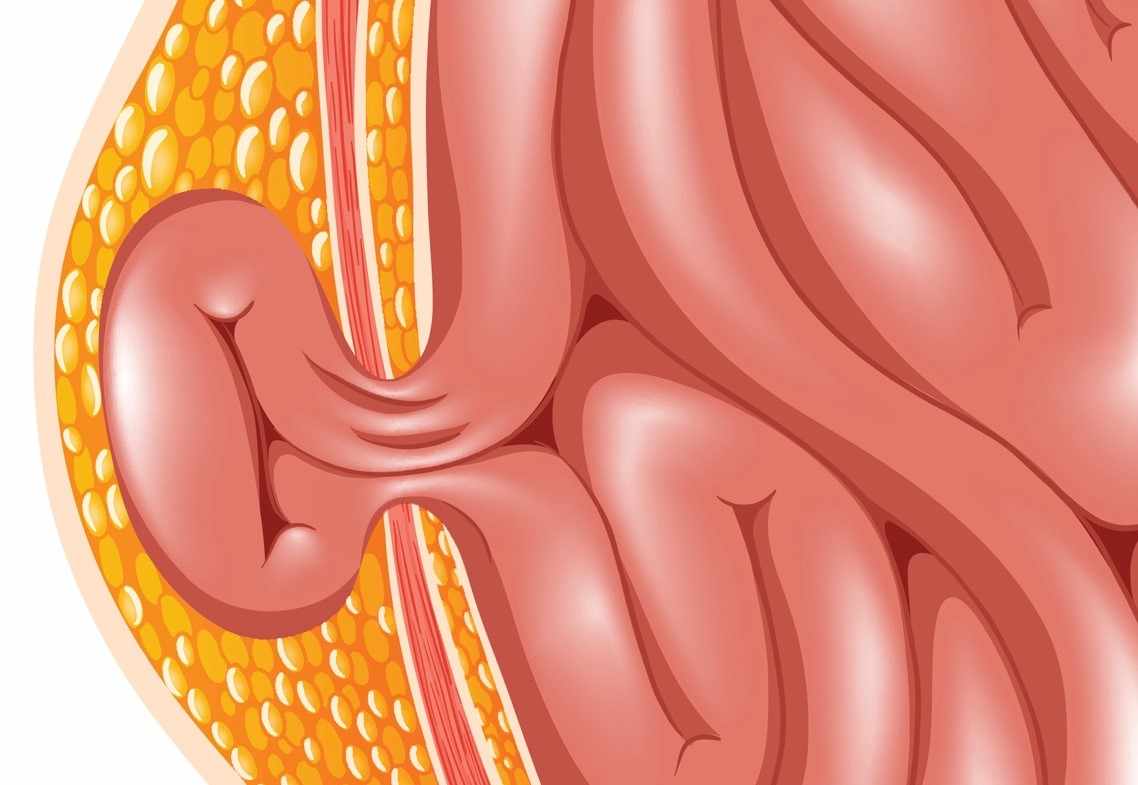 Hernia Surgery Cost Singapore: Key Factors That Affect Your Final Bill