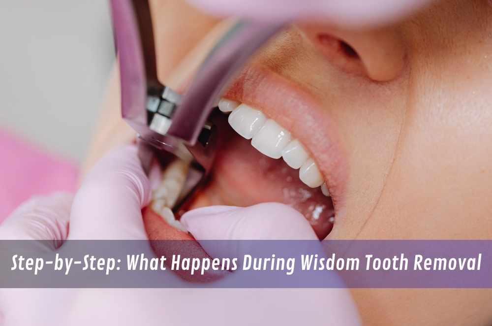 Step-by-Step: What Happens During Wisdom Tooth Removal