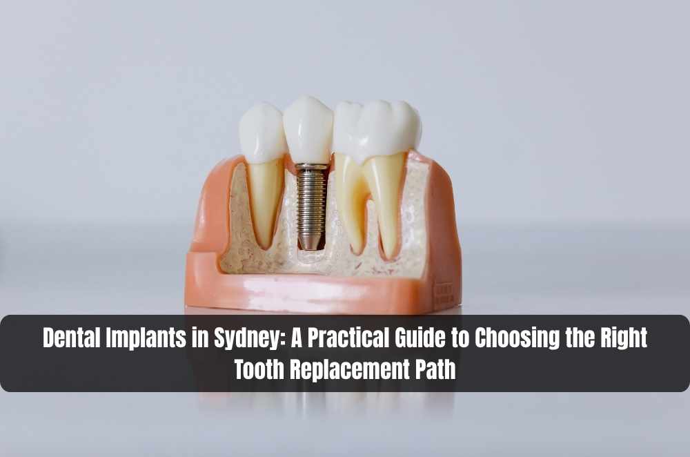 Dental Implants in Sydney: A Practical Guide to Choosing the Right Tooth Replacement Path