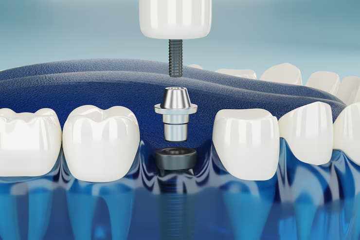 What Makes Dental Implants in Derby a Top Choice Among Patients?