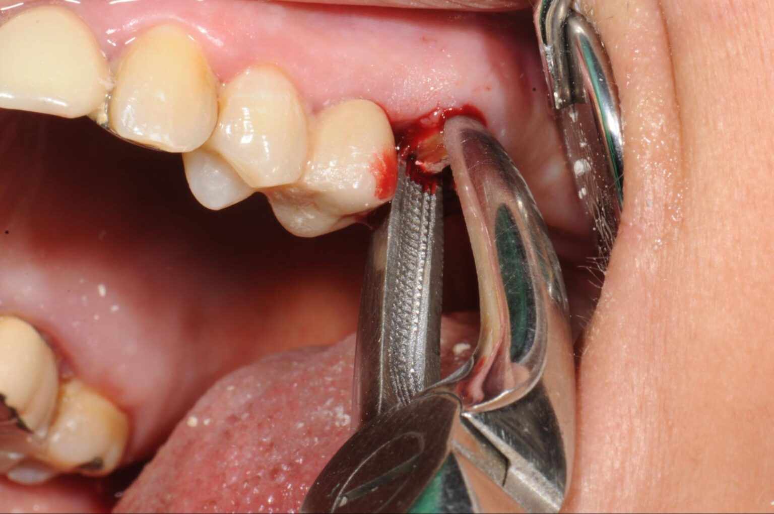 Advanced Surgical Tooth Extraction in  Noida for All Dental Emergencies