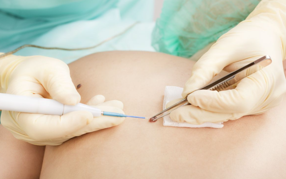 Complete Skin Treatment Solutions in Maidenhead – From Skin Cancer Screening to Lesion Removal