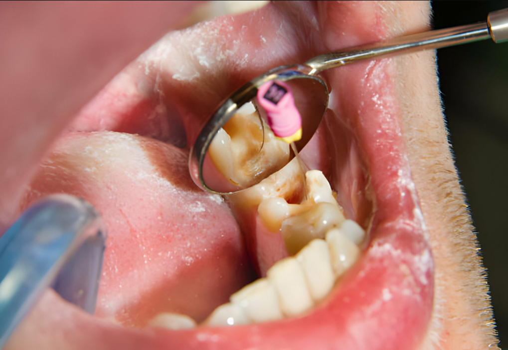 From Missing Teeth to Confident Smiles: Implant Supported Dentures in Sector 12 Noida