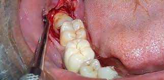 Surgical Tooth Extraction Sector 12 Noida: Safe, Comfortable & Expert Dental Care