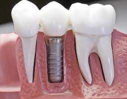 Implant Supported Dentures in Sector 12 Noida – A Simple Guide to Better Smiles