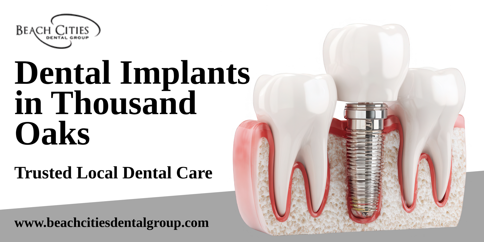 Dental Implants in Thousand Oaks – Trusted Local Care