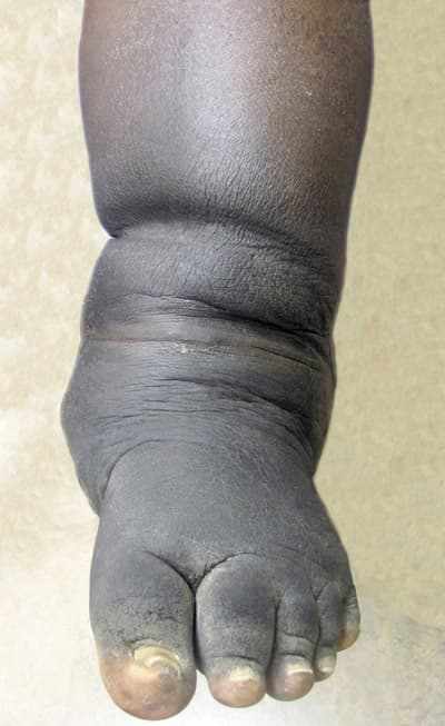 The Role of Diabetes in Charcot Neuroarthropathy: What You Need to Know