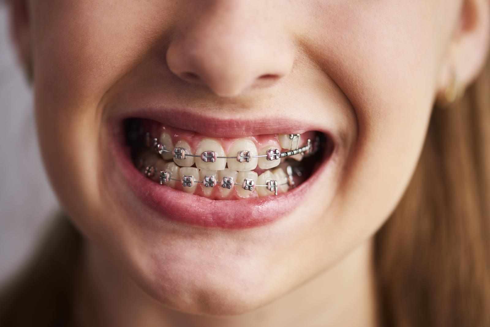 Straighten Your Smile with Dental Braces in Saskatoon