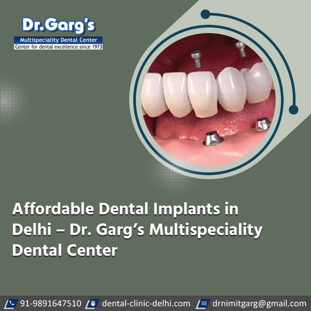 Affordable Dental Implants in Delhi – Dr. Garg’s Multispeciality Dental Center