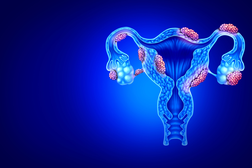 Endometriosis and Fertility: What You Need to Know