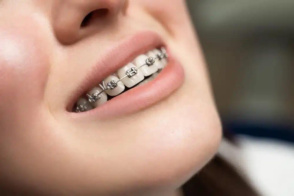 Expert Orthodontic Treatment Near You – When You Choose Theurer Smile, You’re Choosing the Best