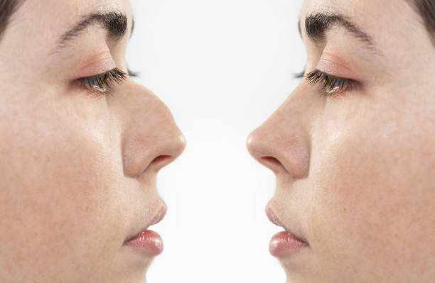 Rhinoplasty Surgery Before and After: Real Transformations